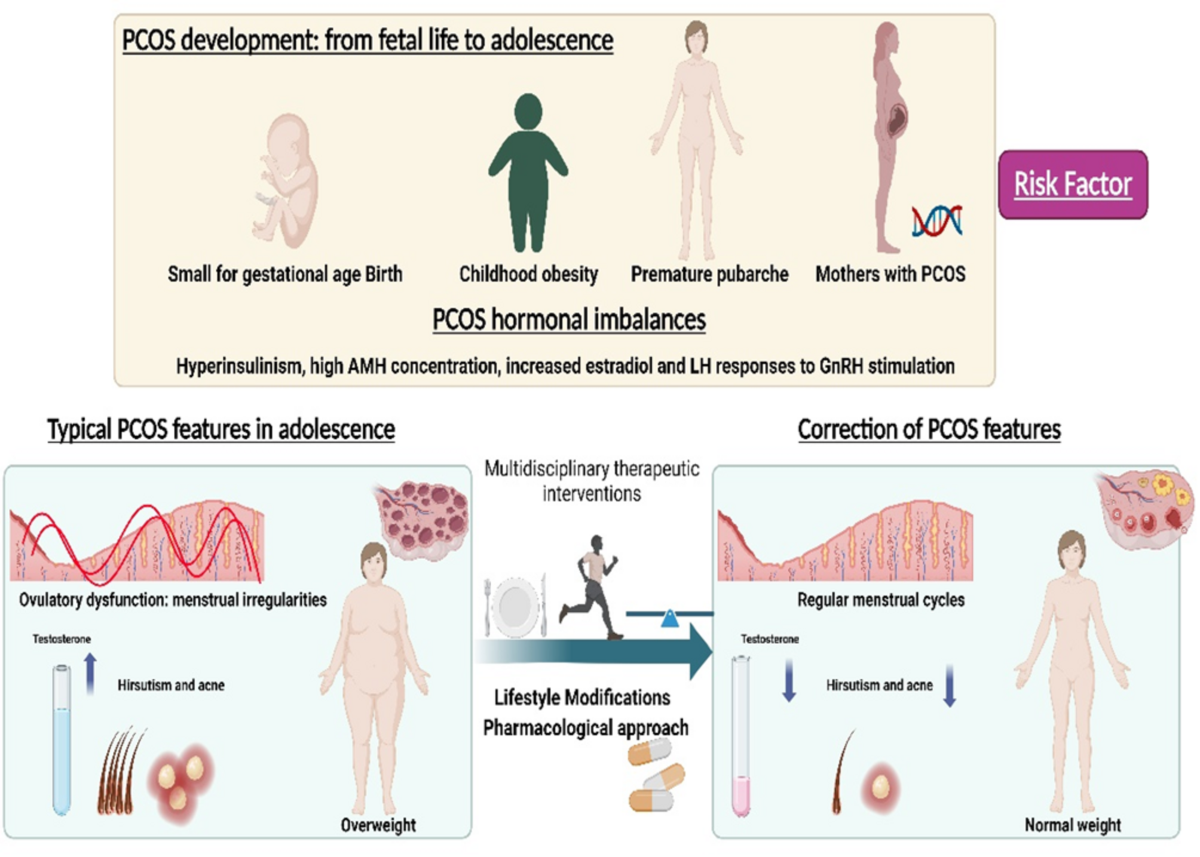 Herbal treatment of PCOS